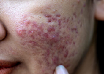 Iš nieko atsirandantys šašai ant veido. Kas tai?