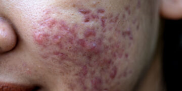 Iš nieko atsirandantys šašai ant veido. Kas tai?