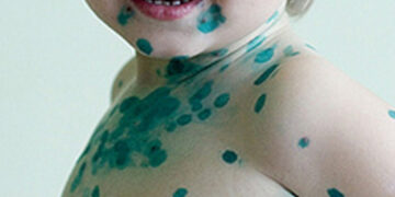 Ikimokyklinėse įstaigose siaučia vėjaraupiai