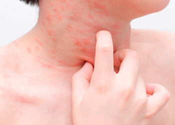 Sergamumą tikimasi šį mėnesį pažaboti