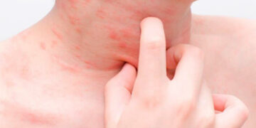 Sergamumą tikimasi šį mėnesį pažaboti