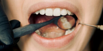 Dantų implantai: Privalumai ir trūkumai