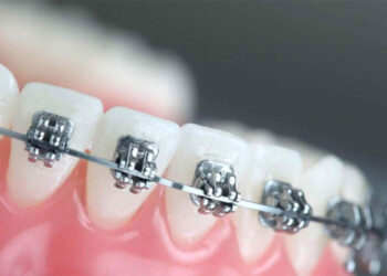 Kompensuojamas Ortodontinis gydymas!