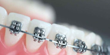 Kompensuojamas Ortodontinis gydymas!