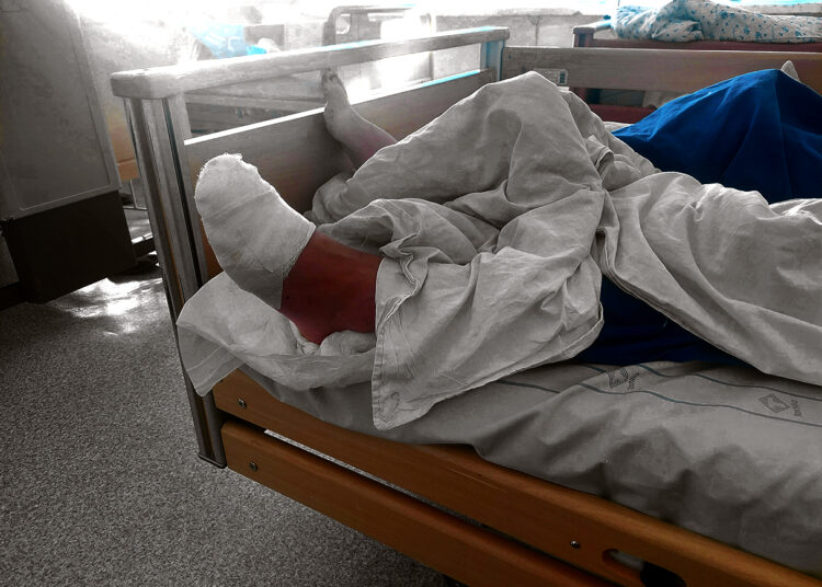 Nušalusius pirštus teks amputuoti