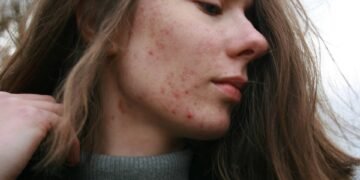 Dermatologas turėtų apžiūrėti net ir nedidelius odos pokyčius, tad neatidėliokite vizito